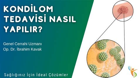 Kondilom Tedavisi Nas L Yap L R Op Dr Brahim Kavak Idea Klinik