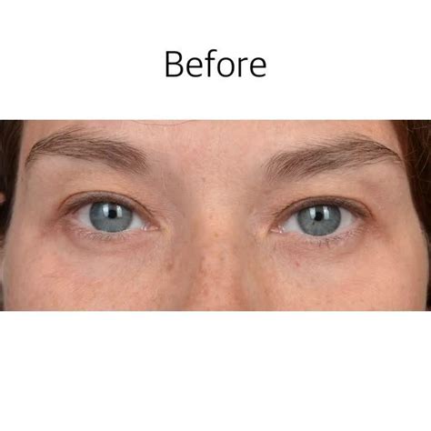 Upper Eyelid Blepharoplasty Video Realself