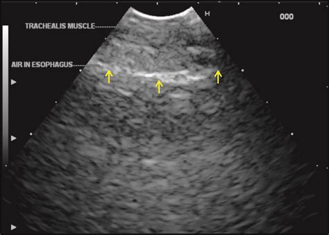 Techniques Of Linear Endobronchial Ultrasound Intechopen