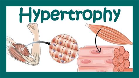 Hypertrophy | What is hypertrophy? | Mechanism of muscle hypertrophy ...