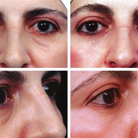 PDF Hyaluronic Acid Injections For Correction Of The Tear Trough