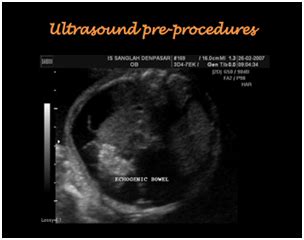 Meconium Ileus Ultrasound