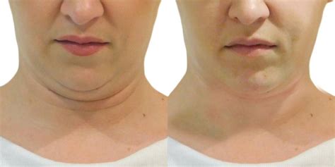 Strawberry Neck And Chin Lift Lipo Laser Nj