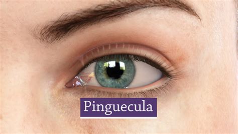 What Is A Pinguecula And A Pterygium Surfers Eye Prima Health