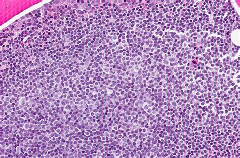 Lymphoma Blog