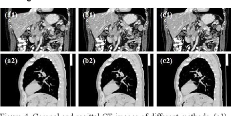 Figure 4 From Denoising Low Dose Ct Images Using A Multi Layer