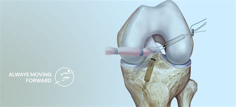 ACL Reconstruction Surgery, ACL Surgery, Dr Vinay Tantuway