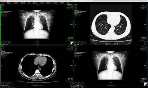 【c 医学影像pacs】ct检查中的三维重建是什么检查？ 阿里云开发者社区
