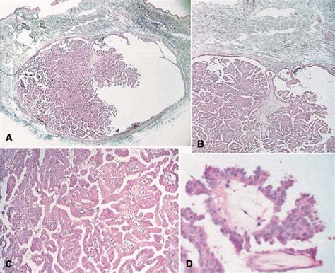 Hidradenoma Papilliferum Occurring On The Chest Of A Man Journal Of