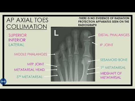 Radiographic Image Evaluation Of Ap Axial Ap Oblique Toes Youtube