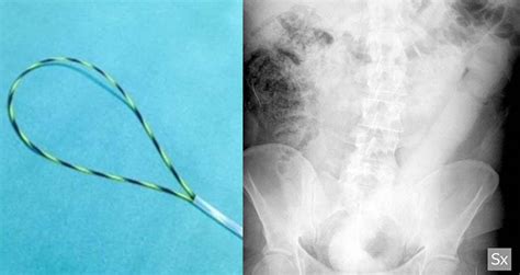 Doctor S Forced To Invent Tool That Can Remove Inch Dildo From Man