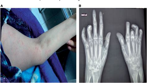 Figure From Severe Destructive Arthritis In Adult Onset Stills