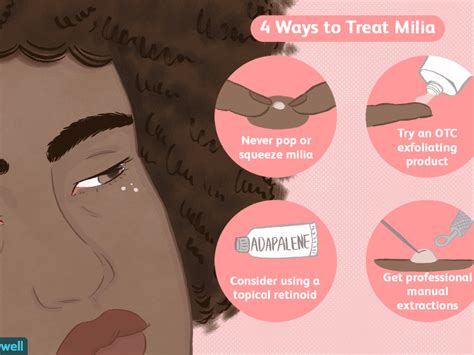 How To Get Rid Of Milia On Upper Eyelid