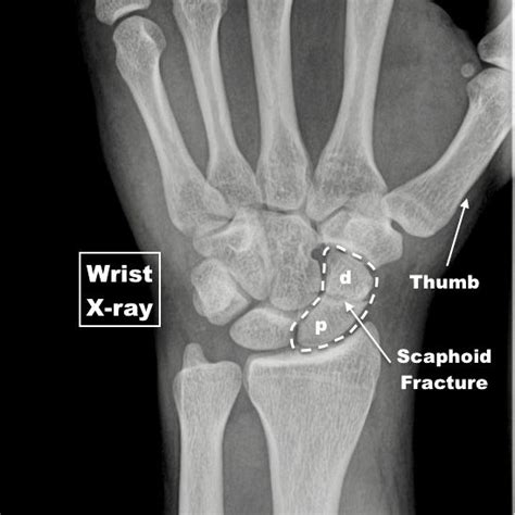 Diagnosis and Management of Scaphoid Fractures