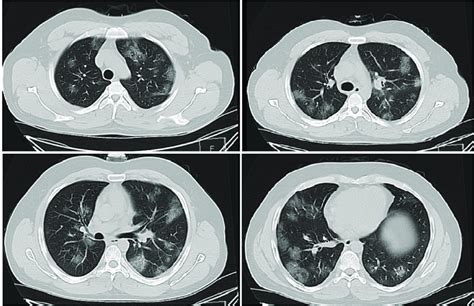 Chest Mdct Lung Window Axial Plane Bilateral Multi Lobar Multifocal