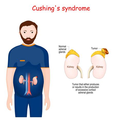 Cushing Syndrome: Everything You Need to Know - REPC