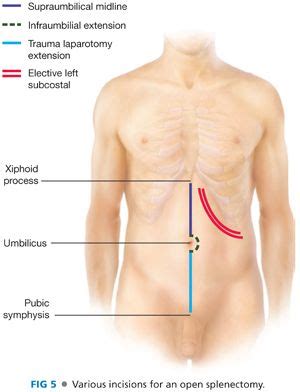 Left Subcostal Incision