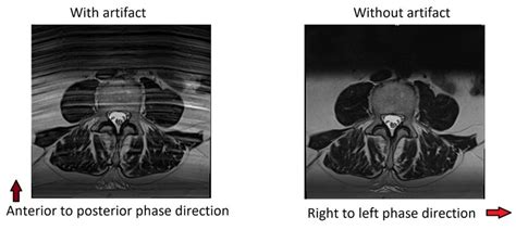 Mri Artifacts Mri Motion Artifact Ghosting Artifact Mri