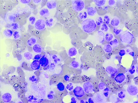 Cyto Smear Showing Both Mature And Immature Myeloid Series Cells