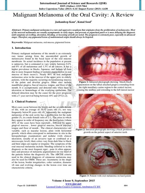 1 Malignant Melanoma Of The Oral Cavity A Review Melanoma Cancer