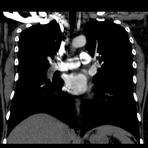 Saddle Pulmonary Embolism Image