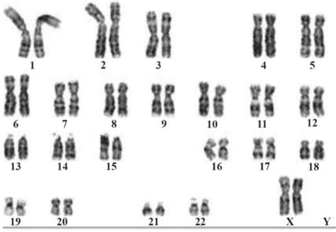 Patient With Disorders Of Sex Development DSD A Case Report From A