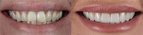 Immediate Dentures Before And After