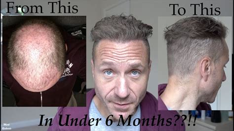 Hair Transplant In Turkey Months Results Aged Things You Need To