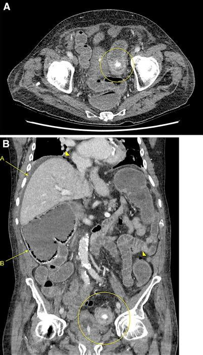 A Axial Image Of Portal Venous Ct Abdomen Shows Soft Tissue Density Download Scientific Diagram