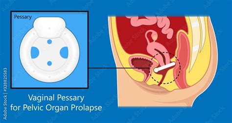 Pelvic Floor Prolapse Type Uterine Uterus Biofeedback Pelvic Floor