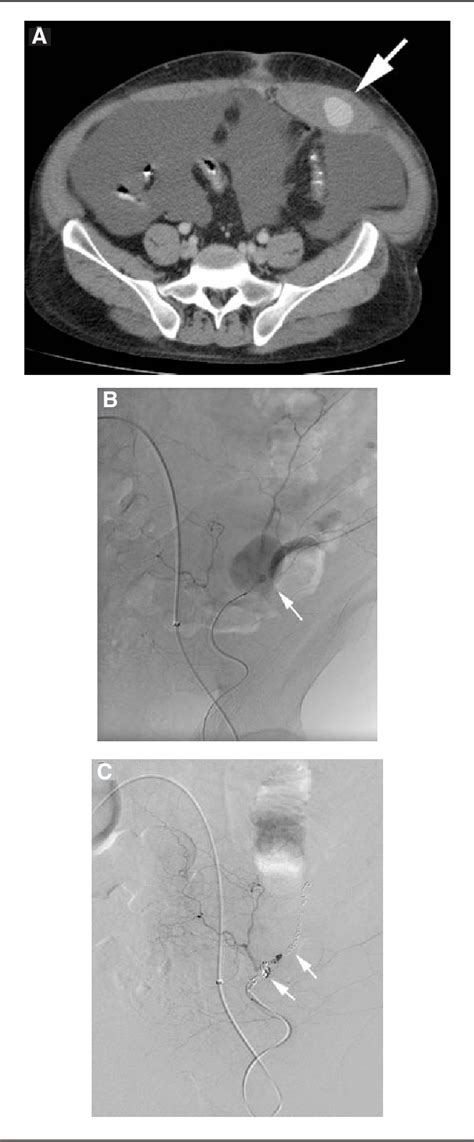 Figure From Transarterial Embolization For Inferior Epigastric Artery