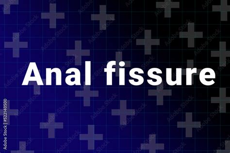 Ilustração do Stock Anal fissure disease Illustration Anal fissure title on medical background