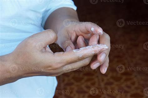 Closeup hand applying medicinal cream on infectious fingers. Concept