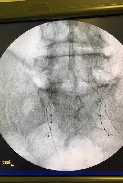 Neuromodulation Redding Pain Medicine