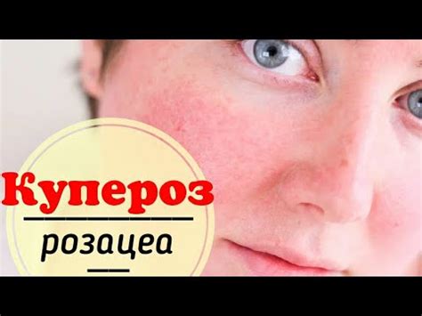 Купероз и розацеа - YouTube