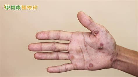 手腳紅斑不癢！他問AI竟罹「梅毒二期」 醫點頭揭成因 - 健康醫療網