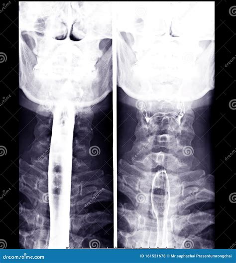Esophagram or Barium Swallow AP View. Stock Photo - Image of healthcare