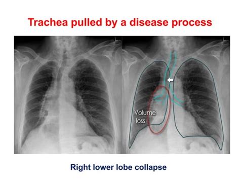 Chest Xrays Step By Step Approach Pptx