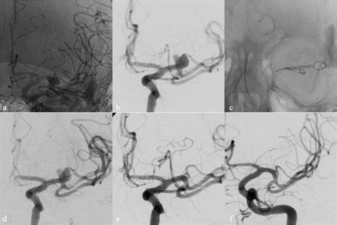 Flow Diverter Devices In The Treatment Of Complex Middle Cerebral