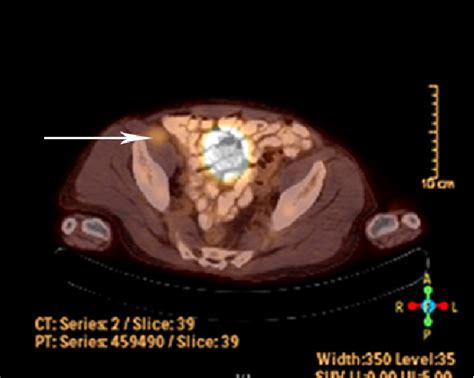 Retroperitoneal Ancient Schwannoma A Case Report And Review Of