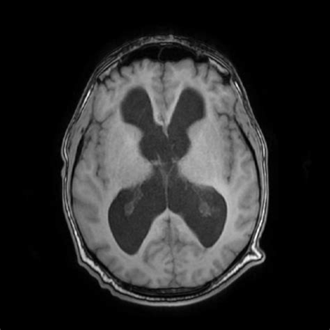Severe Hydrocephalus Mri
