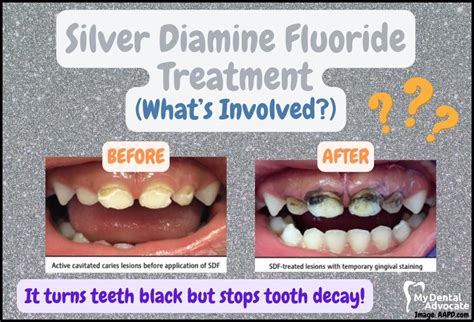 Silver Diamine Fluoride And Its Benefit