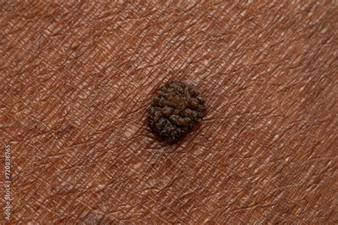 Seborrheic Keratosis On The Skin Of An African Woman Stock Photo