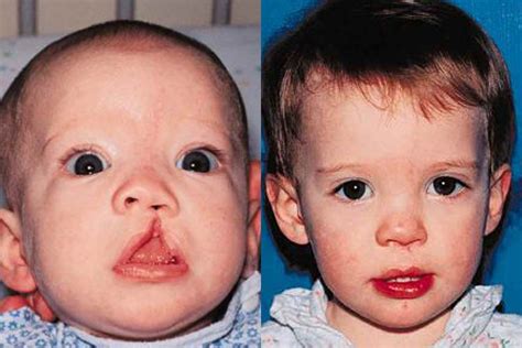 Unilateral Cleft Lip Repair