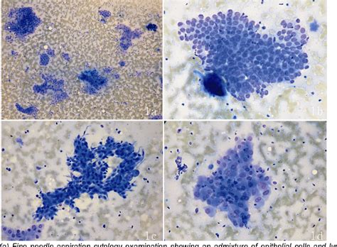 Figure From Cytology Of Hashimoto S Thyroiditis Coexistent With My