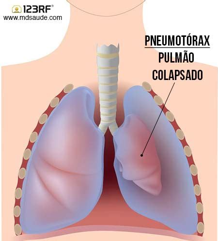 O Que Causa Pneumotorax
