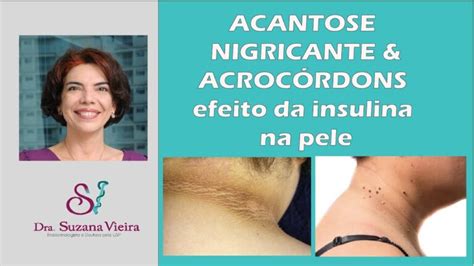 O Que É Acrocordons - Acrocordons: O que são e como tratar | Actualizado mayo 2026
