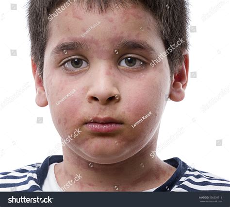Urticaria On Face Close Stock Photo Edit Now 556508518