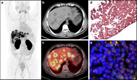 Ga Her Affibody Pet Ct And Pathology Results Of Patient After