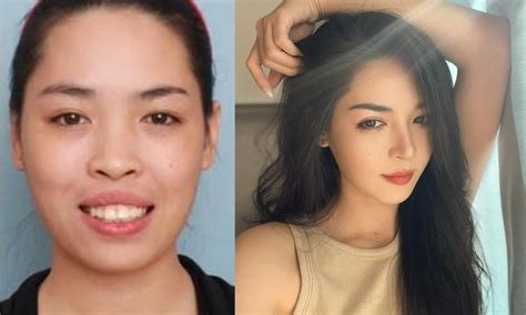 Hot Girl Dao K O V Thanh Qu Nh Ng N Khi Vi C Ch Nh S A Nhan S C Qua N M V N B O L I